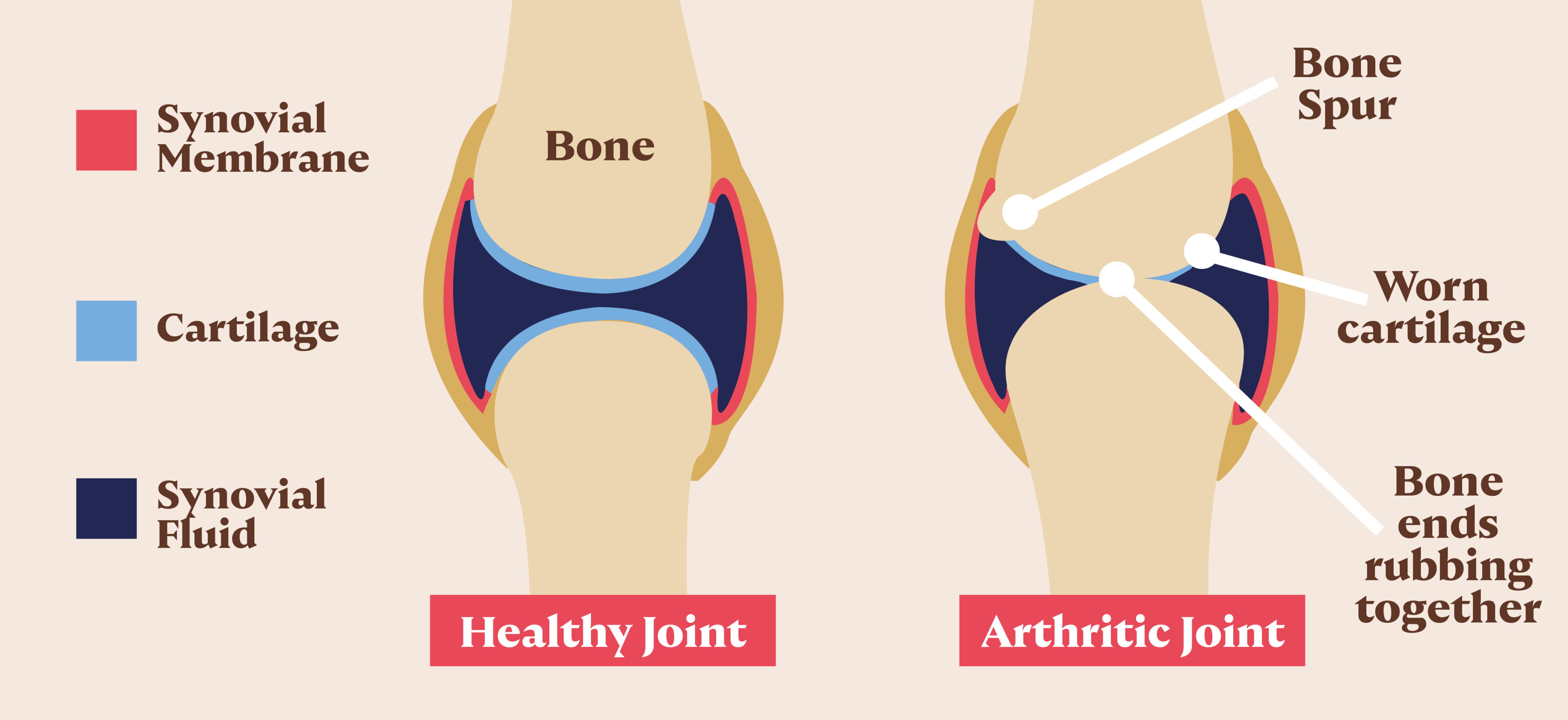 Diagram showing a health joint compared to an arthritic joint